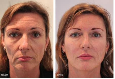 juvederm near me cost