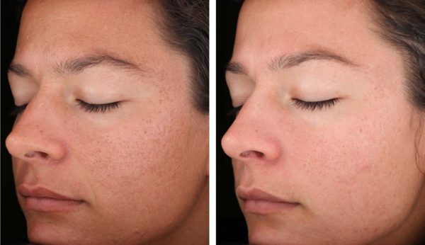 SkinMedica-Illuminize-peel-in-phoenix-arizona