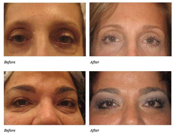 Tightening Skin Under Eyes In Phoenix Az Suddenly Slimmer Med Spa