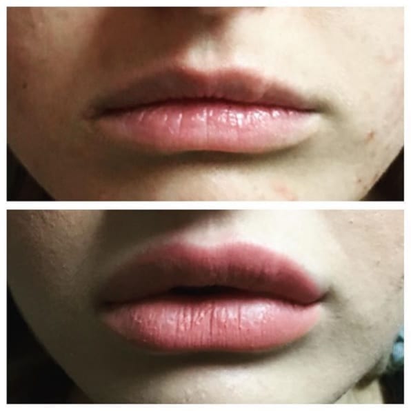 Botox Lip Flip in Phoenix, AZ | Suddenly Slimmer Med Spa Botox Lip Flip in Phoenix, AZ | Suddenly Slimmer Med Spa