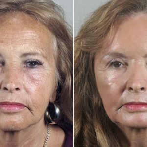 Before-and-after comparison for SkinMedica Vitalize Peel