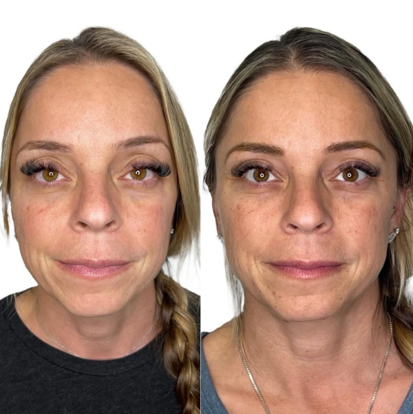 Sculptra Before and After