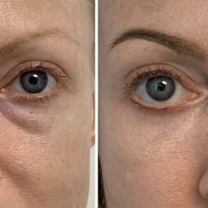 bags-under-eyes-treatment-phoenix-paradise-valley-scottsdale-arizona