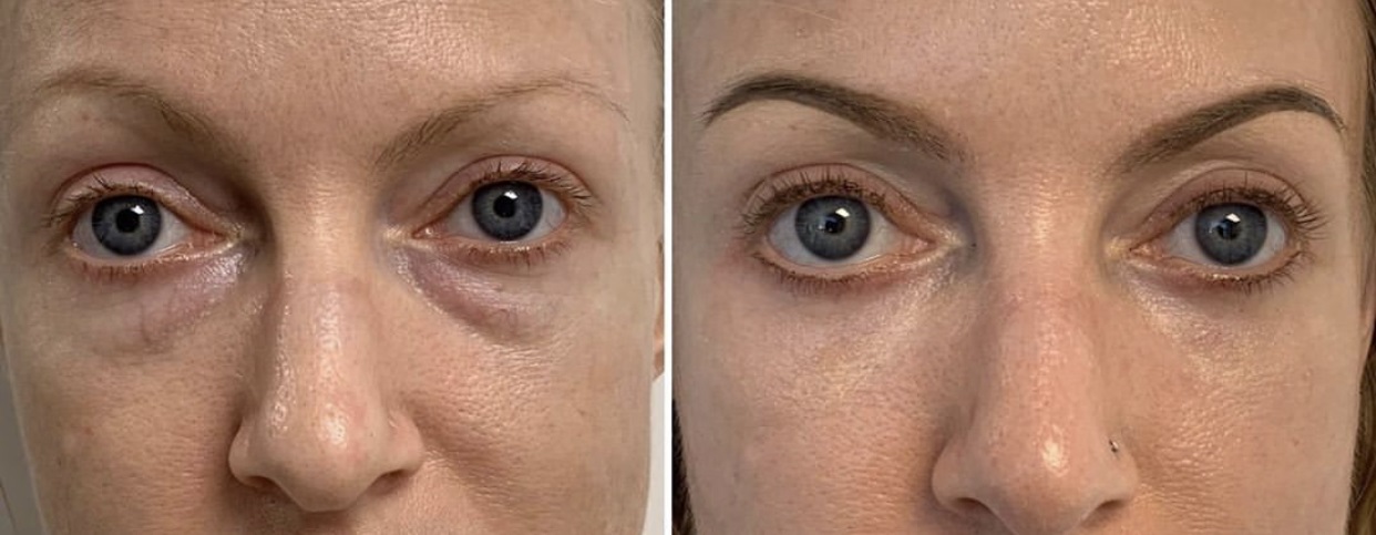 Under Eye Bag Surgery  Prasad Cosmetic Surgery New York