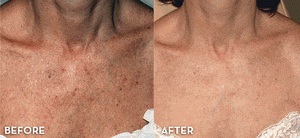 IPL PhotoFacial 3 Sessions - Face & Chest