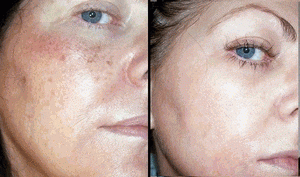 IPL PhotoFacial 3 Sessions - Full Face