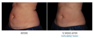 CoolSculpting-Before-After-Pictures-Phoenix