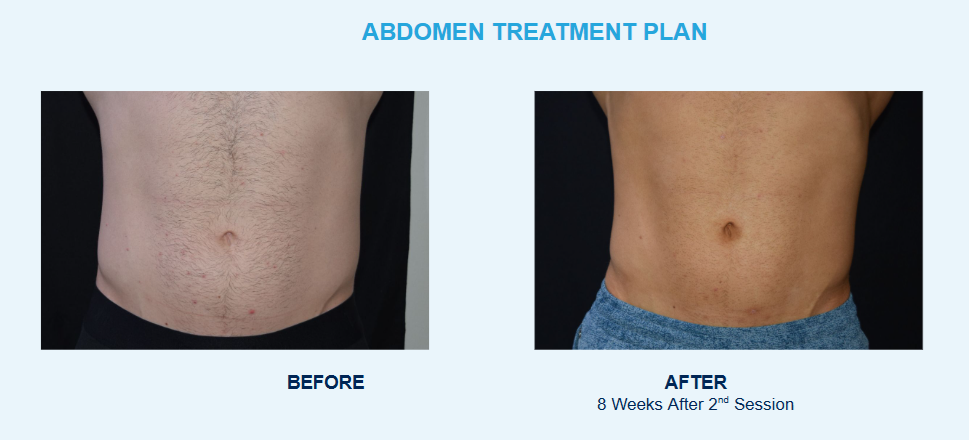 Coolsculpting-before-after-phoenix-AZ