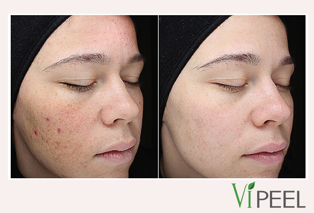 VI-Peel-Precision-Plus-before-after