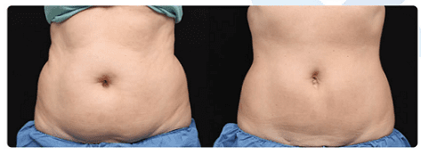 coolsculpting-phoenix-paradise-valley-scottsdale-az