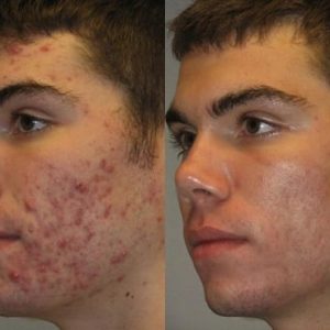 Acne Facial Treatment