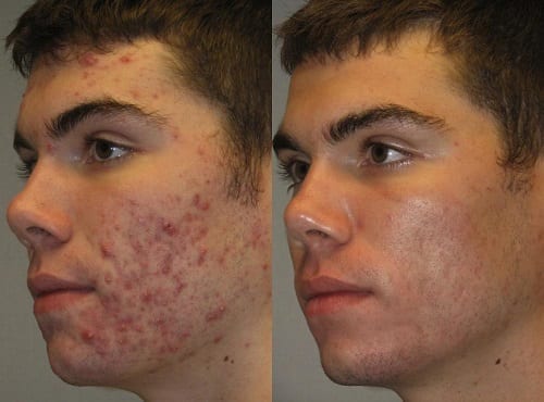 Acne Facial Treatment