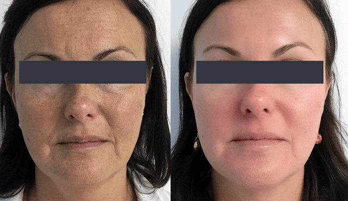 CO2-Laser-Skin-Resurfacing-Phoenix-Paradise-Valley-Scottsdale-Arizona