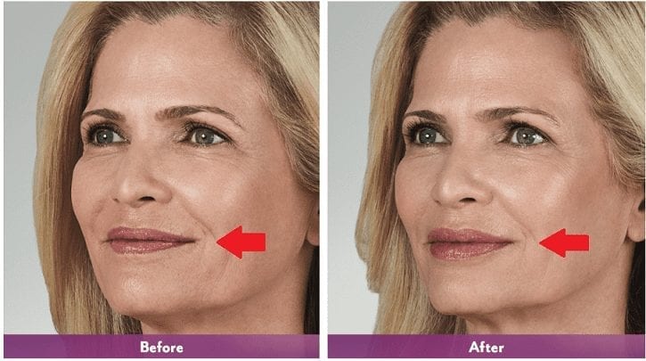 Juvederm-Vollure-XC-Phoenix-Paradise-Valley-Scottsdale-Arizona