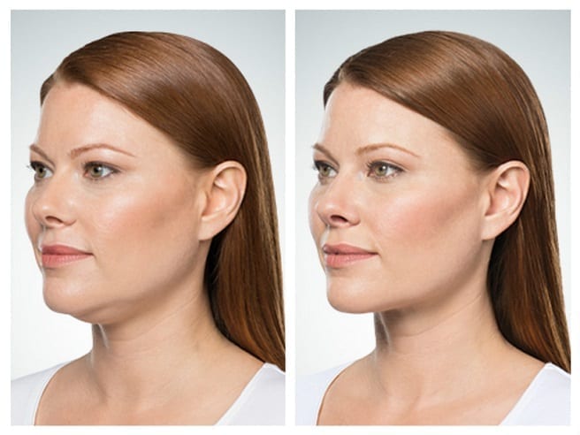 Kybella-Double-Chin-Injection-phoenix-paradise-valley-scottsdale-arizona