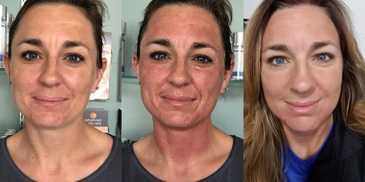 PRP-Platelet-Rich-Plasma-Facial-phoenix-paradise-valley-scottsdale-arizona