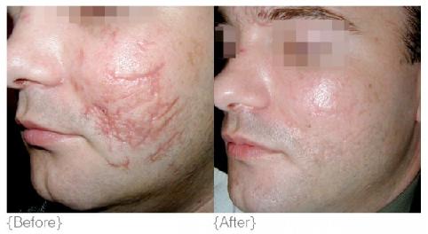 Scar-Removal-In-Phoenix-Arizona