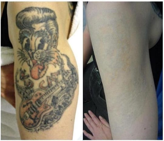 Tattoo-Removal-Phoenix-Paradise-Valley-Scottsdale-AZ