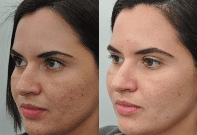 acne-treatment-phoenix-paradise-valley-scottsdale-arizona