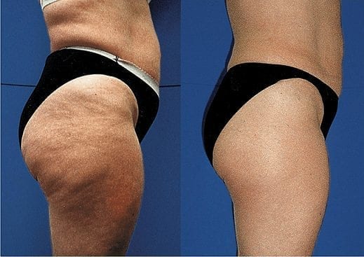 cellulite-treatment-phoenix-paradise-valley-scottsdale-arizona