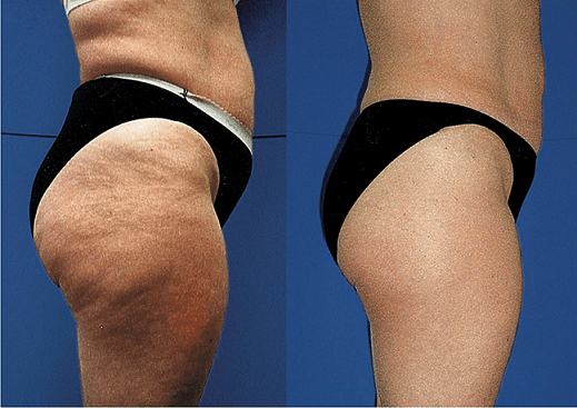 cellulite-treatment-phoenix-paradise-valley-scottsdale-arizona