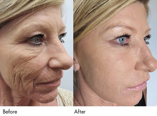 microneedling-prp-phoenix-paradise-valley-scottsdale-arizona-1