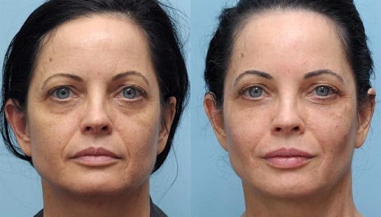 restylane-phoenix-paradise-valley-scottsdale-arizona
