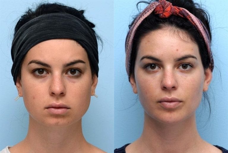 CAN BOTOX BE USED FOR FACE SLIMMING JAW CONTOURING 