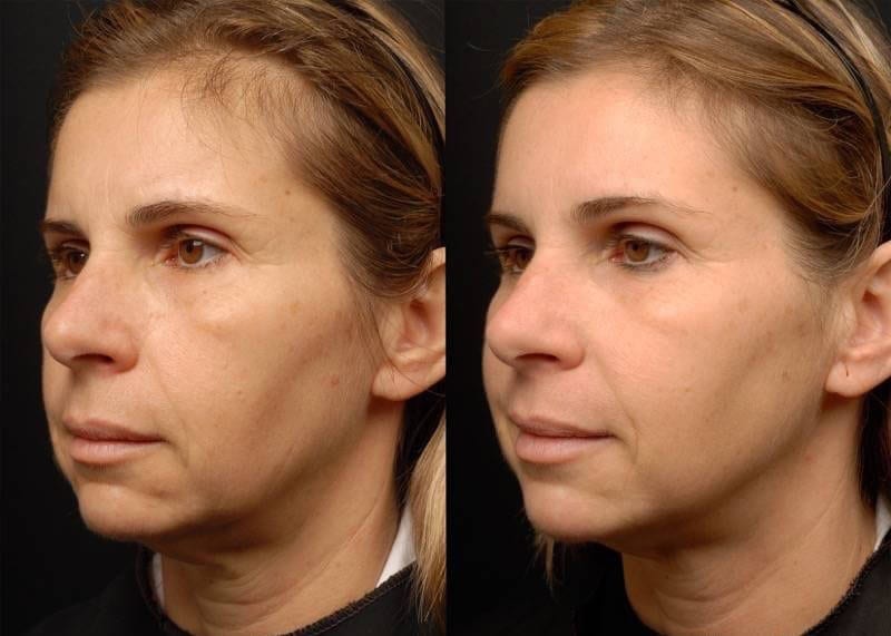 RF-Microneedling-in-Phoenix-Scottsdale-Arizona.jpg