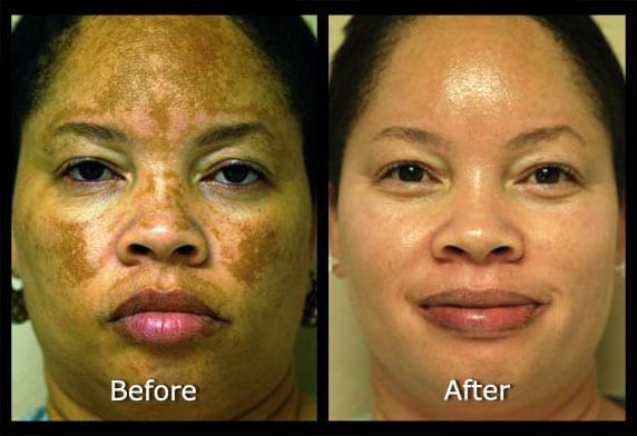 Skin Discoloration Hyperpigmentation In Phoenix Az Suddenly