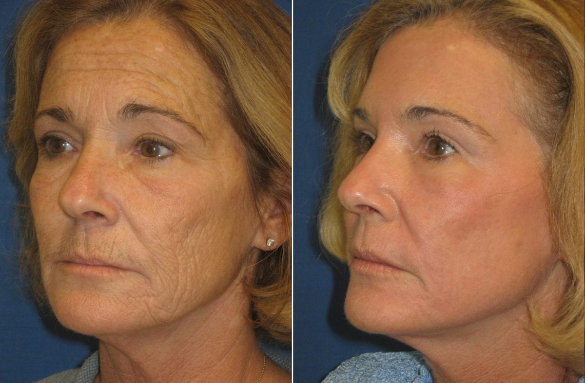 co2-laser-skin-rejuvenation-phoenix-paradise-valley-scottsdale-arizona