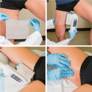 Cryolipolysis for safe and effective inner thigh fat reduction