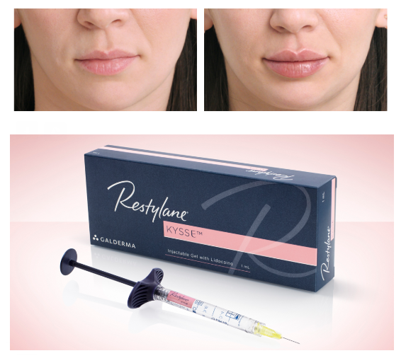 Kysse-Lip-Filler-Phoenix-Paradise-Valley-Scottsdale-AZ