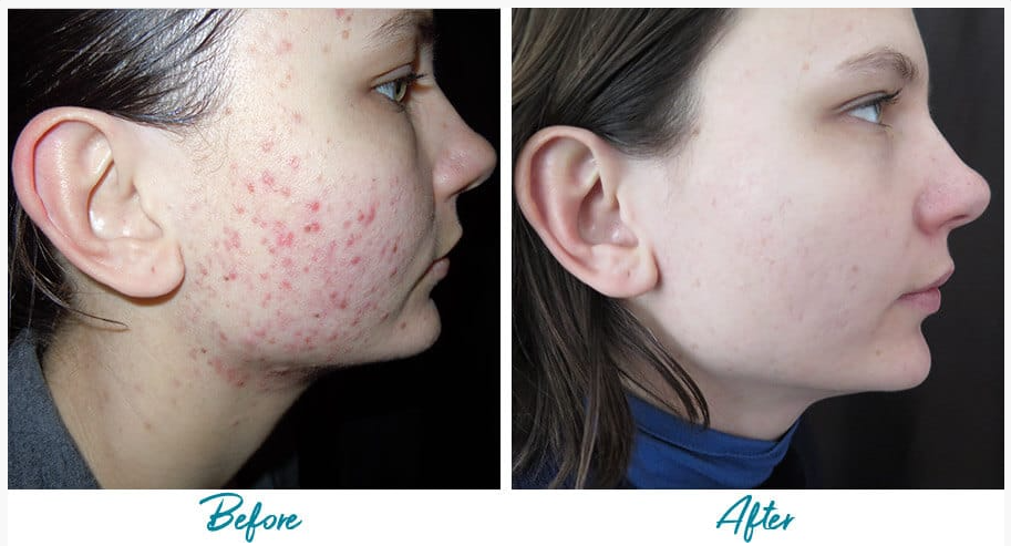 Before-And-After-Pictures-For-Acne-Scar-Treatment