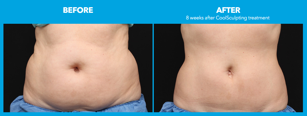 CoolSculpting-Before-After-Pictures-CoolSculpting