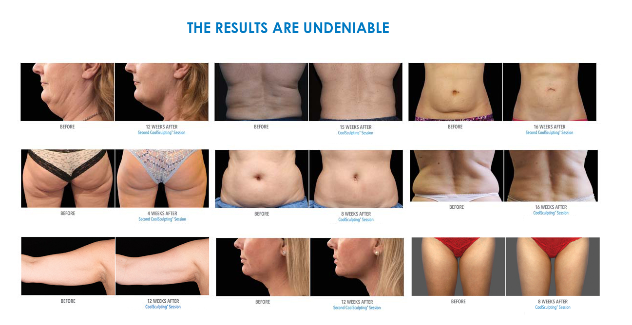 Coolsculpting-phoenix-arizona-1