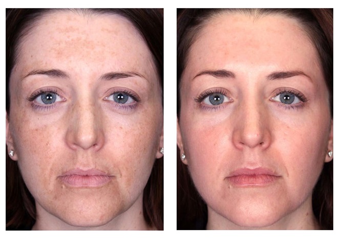 SkinMedica-Peel-Phoenix-Arizona