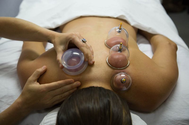 cupping-therapy-in-phoenix-arizona