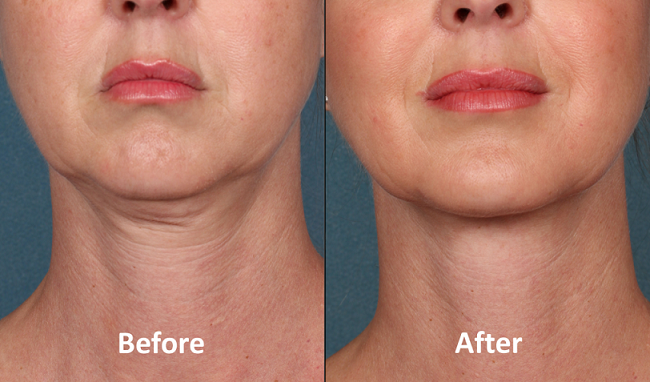 KYBELLA-Patient-Before-and-After