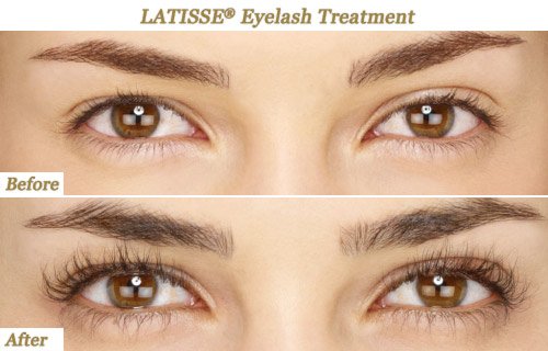 latisse-treatment-before-after-Near-me-Phoenix