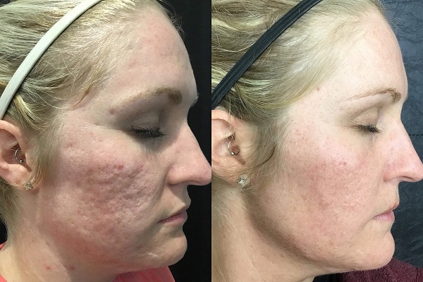 microneedling-before-after