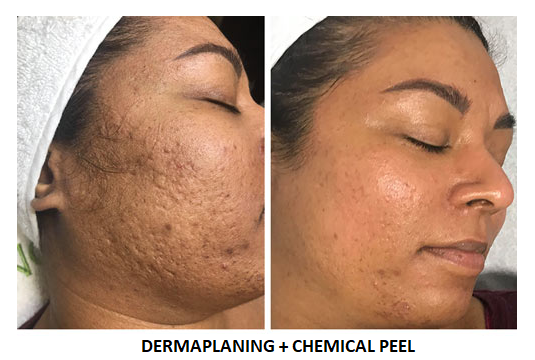 Dermaplaning