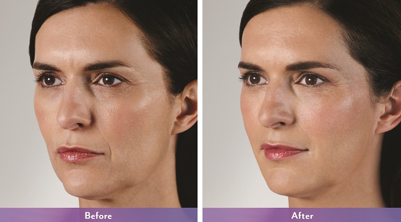 Juvederm-Vollure-Phoenix-AZ