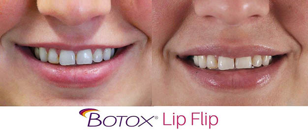 Botox-Lip-Flip-Phoenix-Arizona