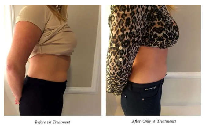 Ultrasonic-Fat-Cavitation-before-after