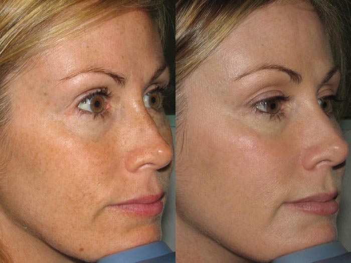 ipl-photofacial-phoenix