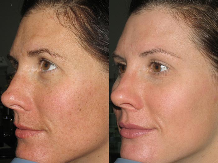 ipl-photofacial-phx-arizona