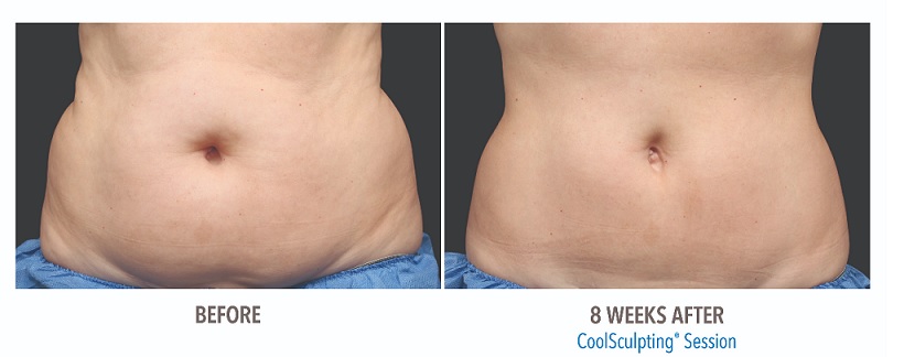 Coolsculpting-before-and-after-cool-sculpting-phoenix-scottsdale-paradise-valley-arizona