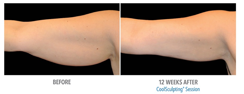 coolsculpting-before-after-underarms-phoenix