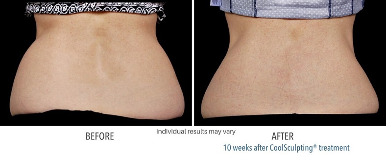 coolsculpting-before-and-after-cool-sculpting-phoenix